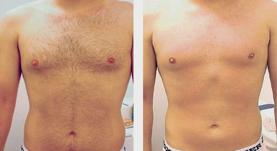 Laser Hair Removal Before and after