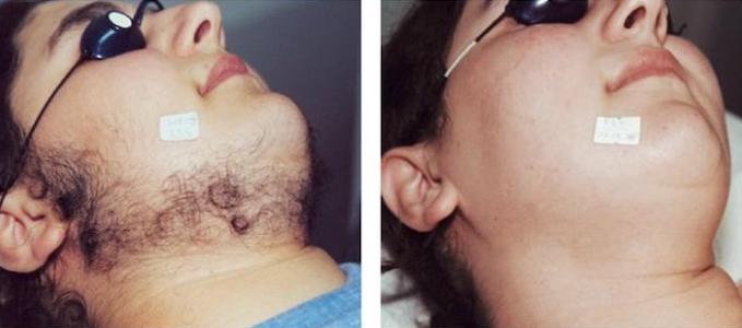 Laser Hair Removal Before and after2