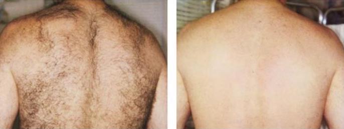 Laser Hair Removal Before and after4