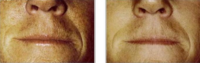 Skin Rejuvenation before and after 