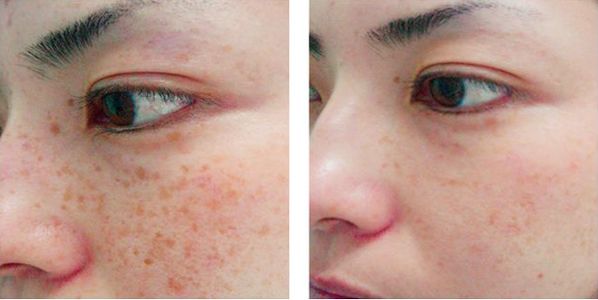 Skin Rejuvenation before and after 3